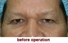 plastic-surgery-blepharoplasty